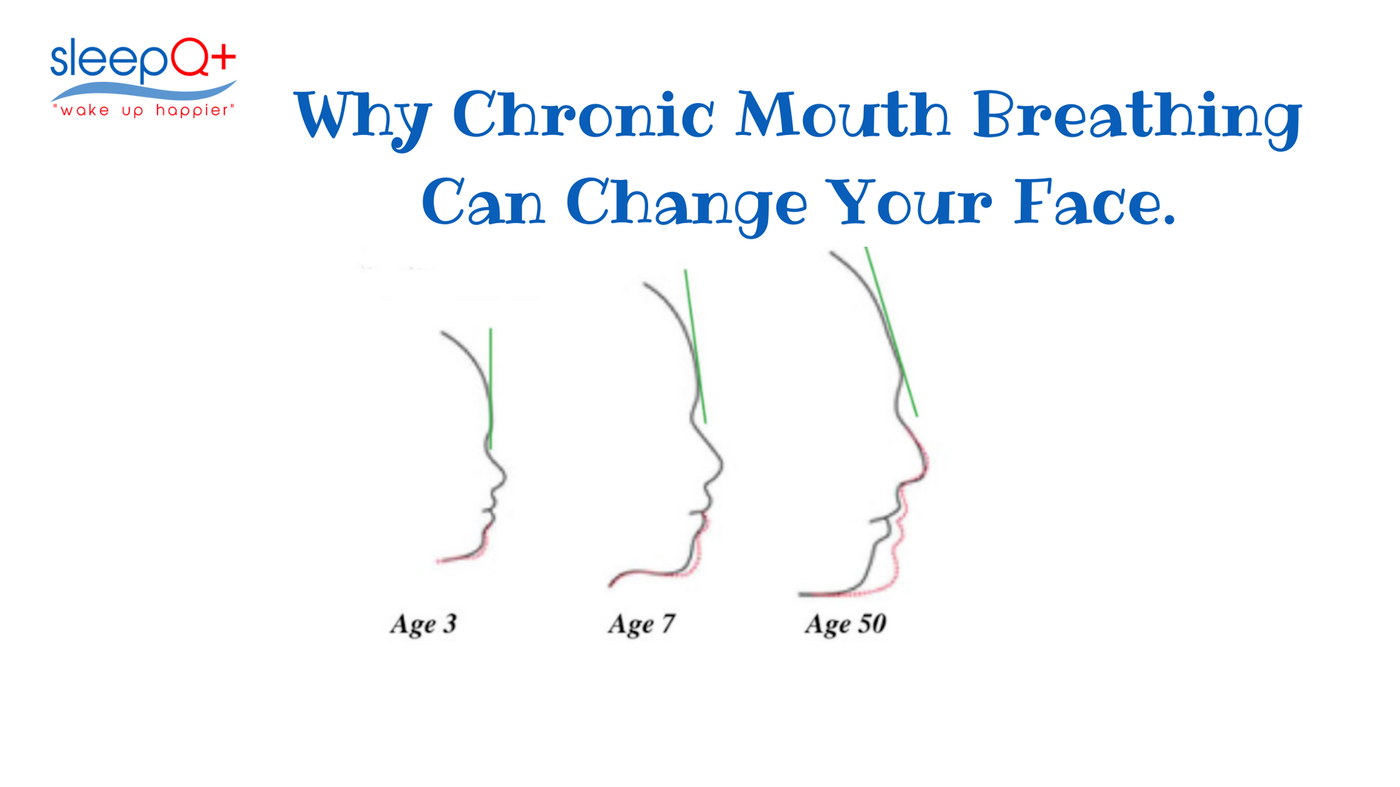 Chronic Mouth Breathing Can Change Your Face Shape