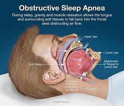 Sleep Apnoea Is More Than Just Extreme Snoring