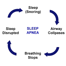 The Different Types Of Sleep Apnea - Obstructive, Central And Mixed.