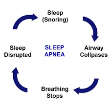 Mixed Apnea Example The Different Types Of Sleep Apnea - Obstructive, Central And Mixed ...