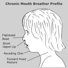 Mouth Breathing Can Change The Shape Of Your Child's Face